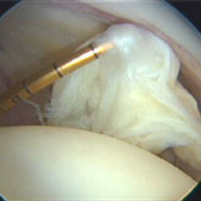 Close-up image of hip arthroscopy surgery.