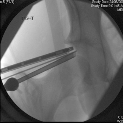 Close-up X-ray image of hip arthroscopy surgery.