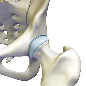 Image of a hip joint.