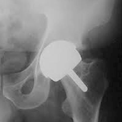 X-ray image of a hip ball and socket showing hip resurfacing