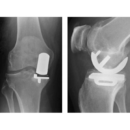 X-ray image of a knee that has had partial knee replacement surgery.