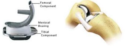 Image of partial knee implant and illustration of knee joint.