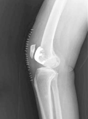 X-ray image of knee after undergoing patello-femoral knee replacement surgery.