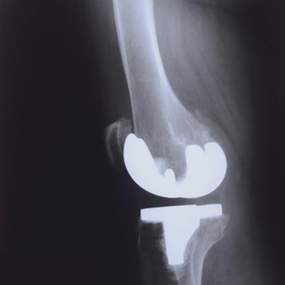 X-ray image of knee that has undergone total knee surgery.