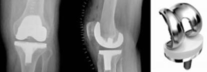 X-ray image of knee that has undergone total knee surgery, also showing knee implant.