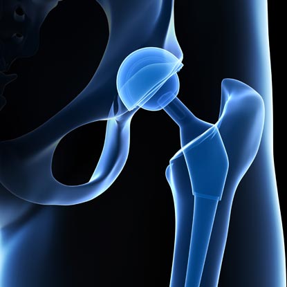 Image of x-ray image of hip joint ball and socket.