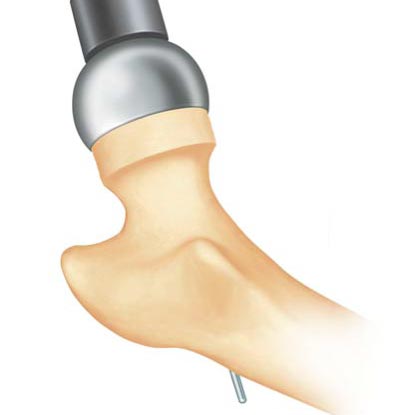 Image of a hip ball and socket showing hip resurfacing.